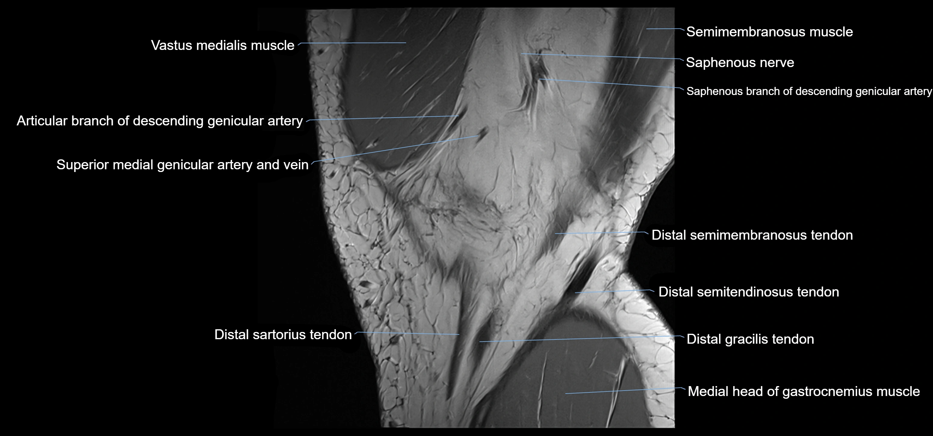 MRI knee sagittal cross sectional anatomy labelled 3T radiology image-00007.webp